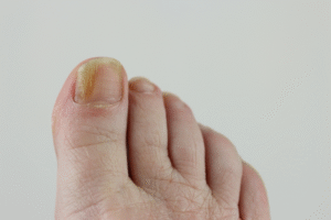 Manicures & Pedicures Prevent Nail Fungus?
