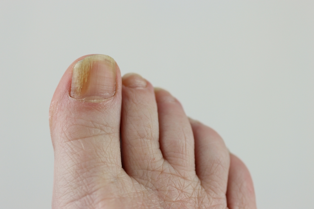 Manicures & Pedicures Prevent Nail Fungus?