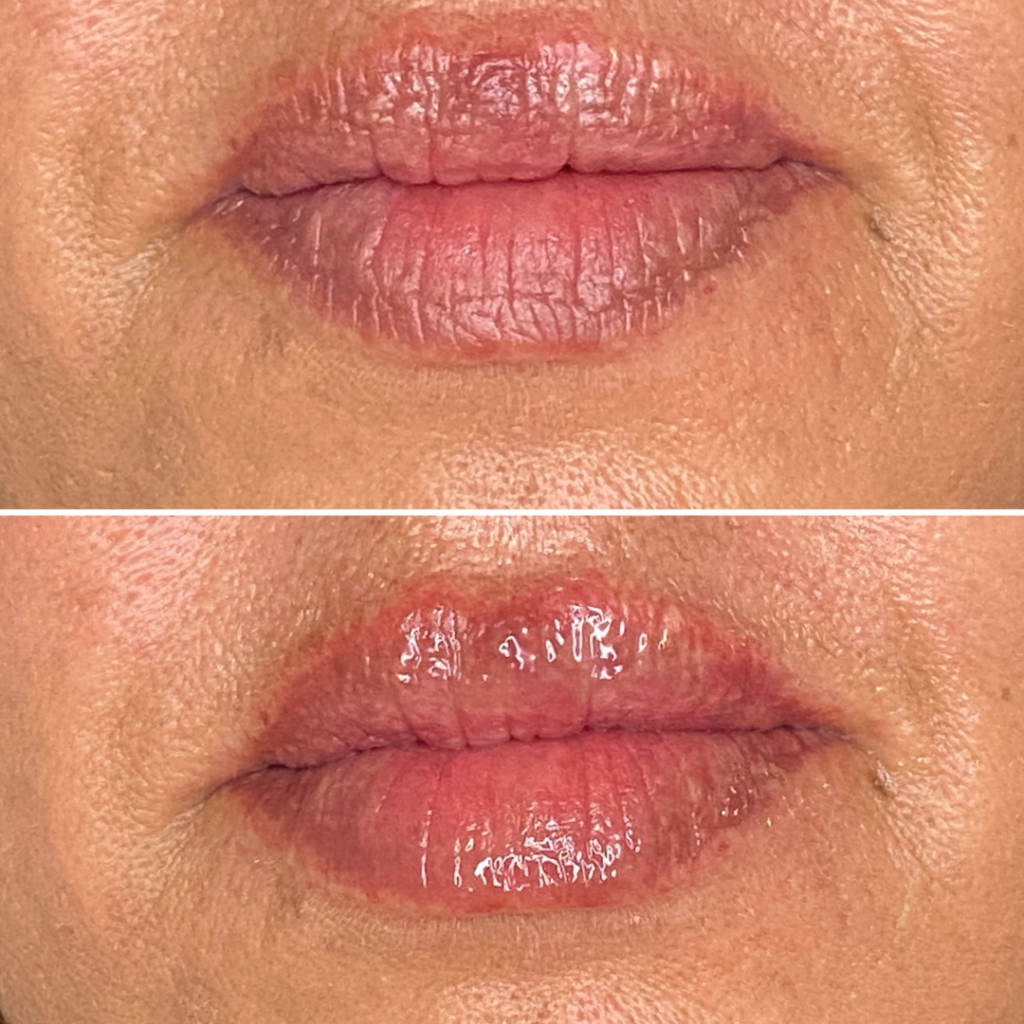 Before After Lips